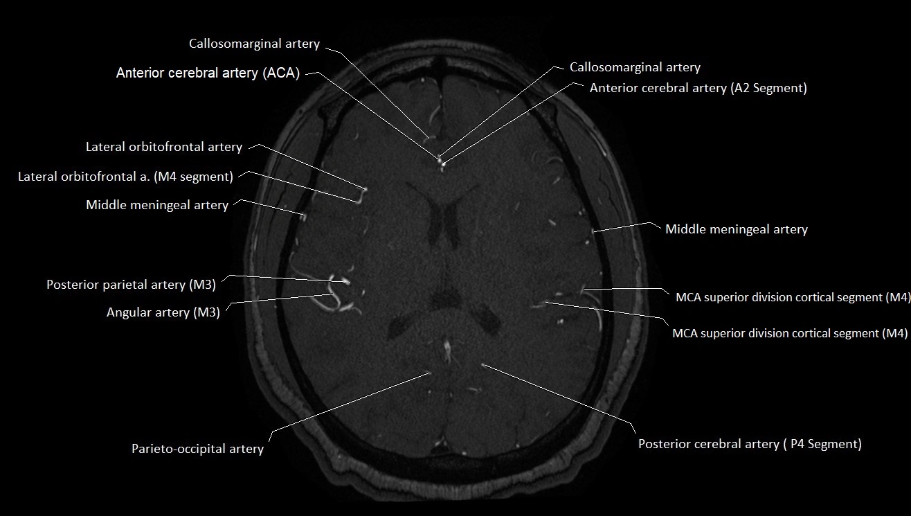 MRA brain (cerebral arteries) anatomy axial 3T image 34.webp